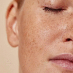 pigmentation on face